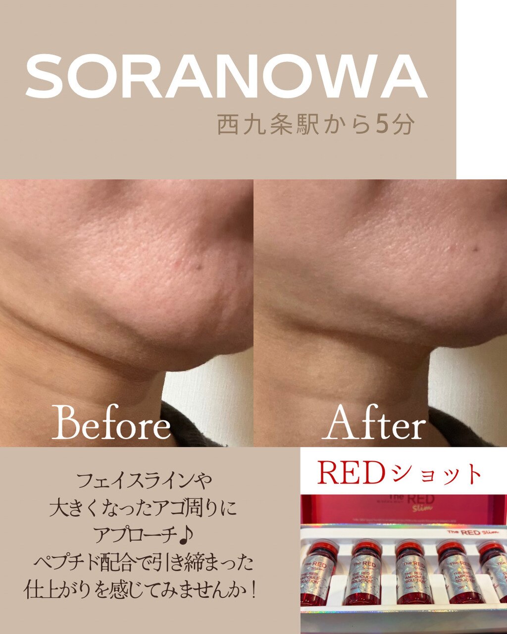 新入荷!フェイシャルをスッキリ♪『REDショット』