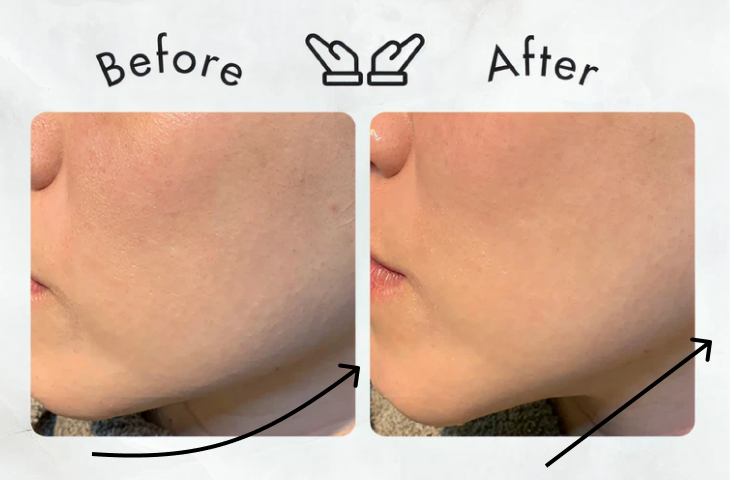 Before After フェイシャルエステの施術前後の写真2