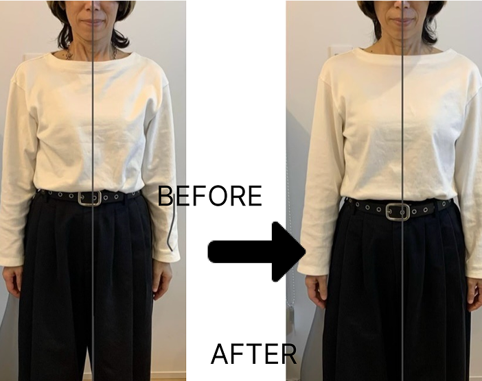 フェムケア施術例 ビフォーアフターの写真